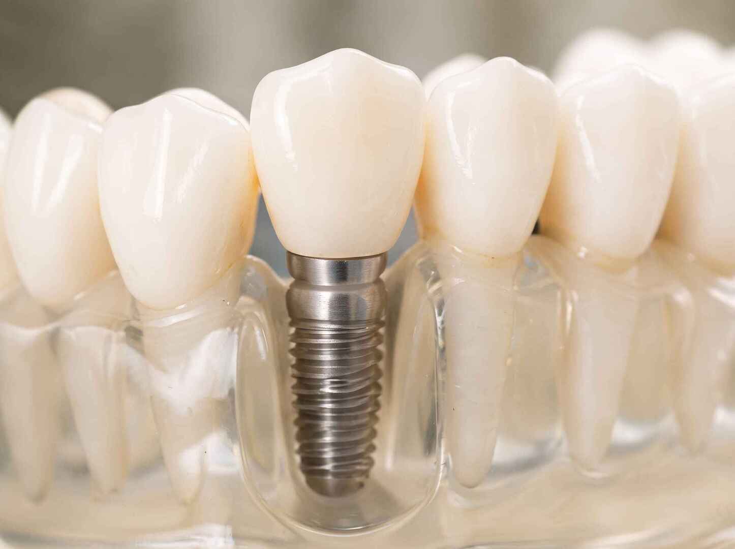 Implantodontia e reabilitação com implantes dentários