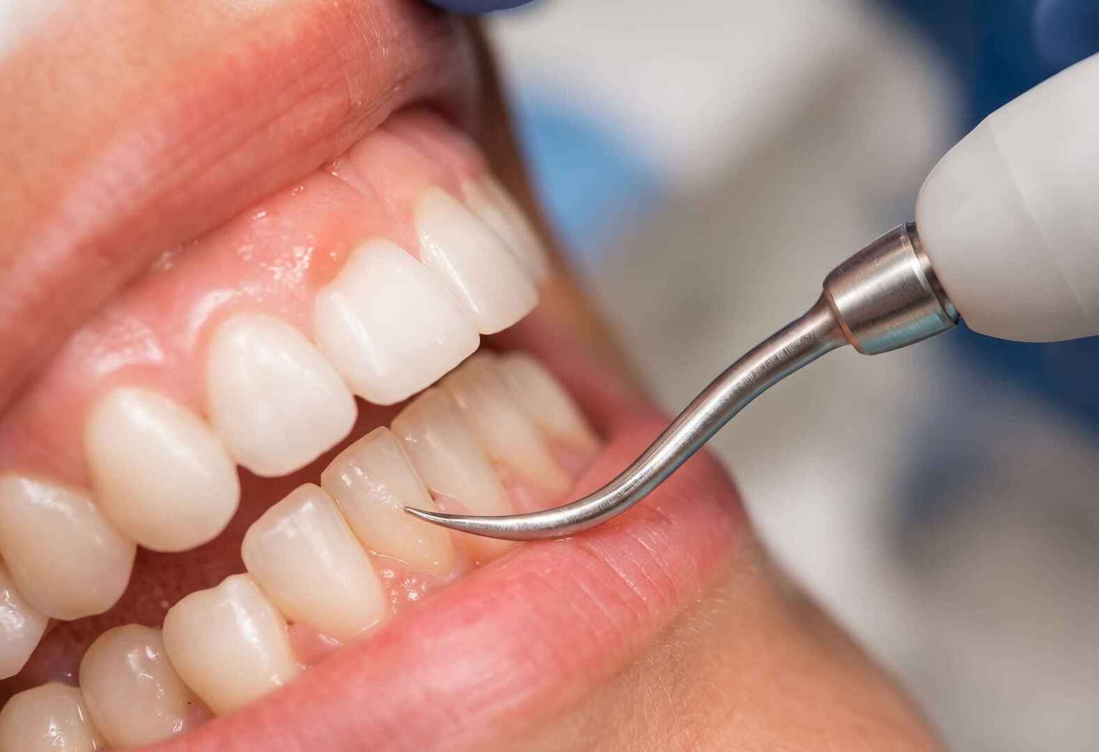 Periodontia e tratamento das doenças gengivais